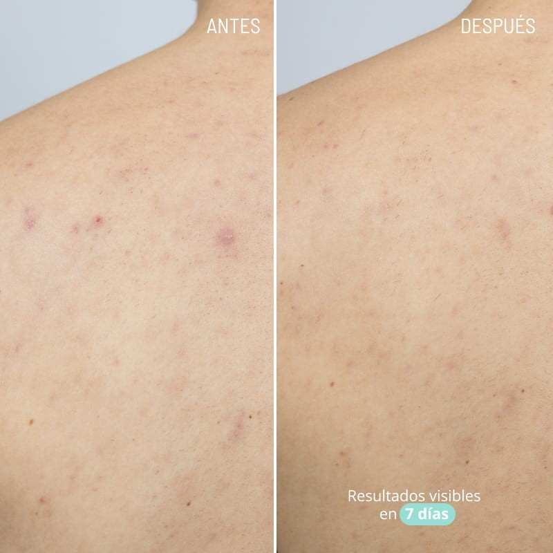 Freshly Cosmetics Azelaic Active Body Treatment 100 ml-2