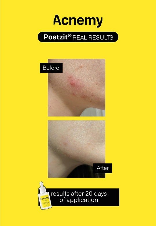 Acnemy Postzit 30 ml-8
