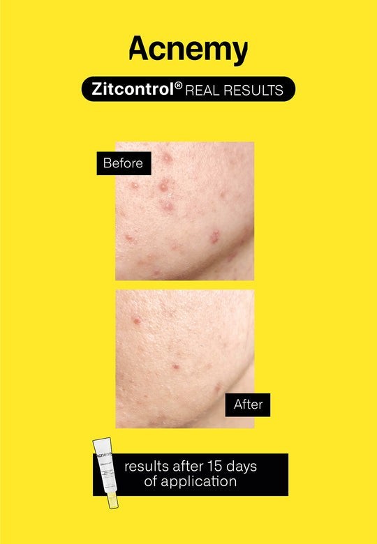 Acnemy Zitcontrol 40 ml-6