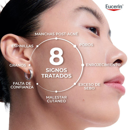 Eucerin DermoPure Clinical PROBIOM8 Kit bei Akne unter Behandlung